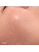 ククル(KUKULU)/陶肌トリートメント9回目