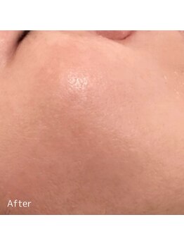 ククル(KUKULU)/陶肌トリートメント9回目