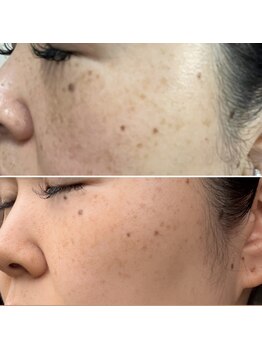 アオイ(AOI)の写真/赤いニキビ・シミ・シワにさよなら！ご自身に合わないケア・間違ったケアで悪化した肌を優しく整えます☆