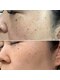 アオイ(AOI)の写真/赤いニキビ・シミ・シワにさよなら！ご自身に合わないケア・間違ったケアで悪化した肌を優しく整えます☆