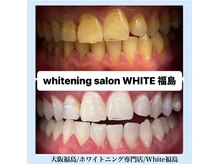 ホワイトニングサロン ホワイト(WHITE)/セルフホワイトニング/大阪/福島
