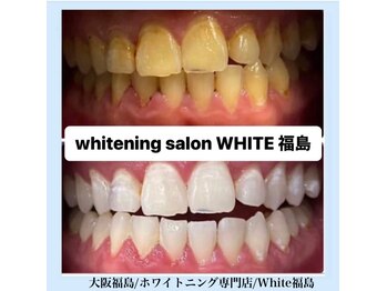 ホワイトニングサロン ホワイト(WHITE)/セルフホワイトニング/大阪/福島