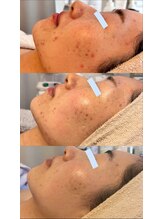 ムニ(muniii)/Before/After