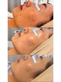 ムニ(muniii)/Before/After