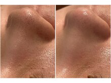 リッツ 所沢店/【Before/After】毛穴