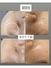 フットミー(foot mii)/シミ・くすみ