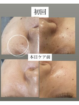 フットミー(foot mii)/シミ・くすみ