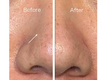 ビナリ 東銀座(BINARI)の写真/【冬限定】眉ラインを整え、毛穴汚れやくすみを徹底ケア。ホワイトニング付きで第一印象を一気に整える☆