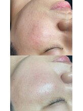 アネモネ(ANEMONE)/韓国式ハーブピーリング