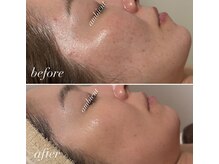 アンビエント(ambient)の雰囲気（ニキビ、肌荒れにはグリーンピール♪本物の肌質改善）