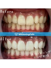 ホワイトニングカフェ 黒崎店(WhiteningCafe)/◎ホワイトニング症例写真◎