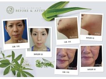 ハーバリー ハーブピーリング 岐阜(HERBERRYハーブピーリング)/ハーブピーリング専門店HERBERRY