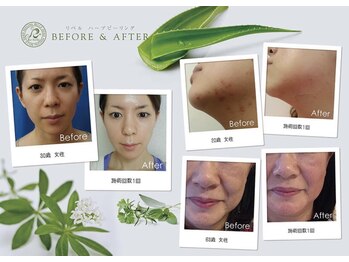 ハーバリー ハーブピーリング 岐阜(HERBERRYハーブピーリング)/ハーブピーリング専門店HERBERRY