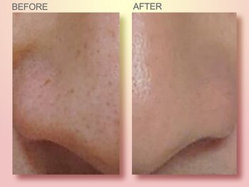 ジュリア オージェ 四条河原町店/ビフォーアフター（鼻スパ）