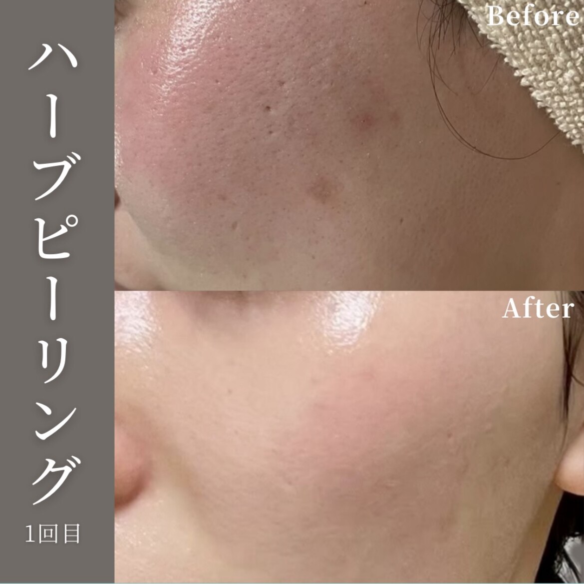 透肌美(トウキビ)｜ホットペッパービューティー