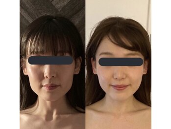 ハイコガオ 中崎町店(HIKOGAO)/小顔矯正