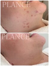 プランス 渋谷(PLANCE)/毛穴/ハーブ/ニキビケア