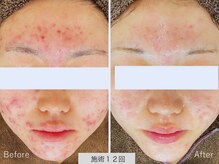 ニキビ研究所 千葉店/赤みを引かせたい・・