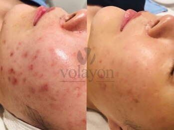 グレイスリリー 表参道(gracelily)/