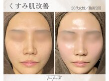 スリースリー 恵比寿(THREE THREE)/くすみ肌・透明感UP ケア