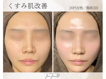 スリースリー 恵比寿(THREE THREE)/くすみ肌・透明感UP ケア