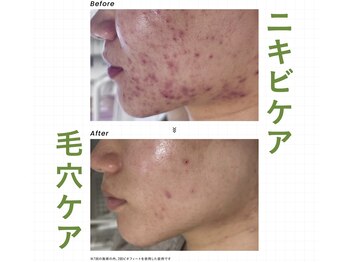 サロンドレヴ(salon de LaEv)の写真/選べるハーブピーリング!毛穴洗浄◎肌悩みに合わせた本格ケア!黒ずみ・詰まり・開き、気になる毛穴悩みに♪