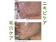 サロンドレヴ(salon de LaEv)の写真/選べるハーブピーリング!毛穴洗浄◎肌悩みに合わせた本格ケア!黒ずみ・詰まり・開き、気になる毛穴悩みに♪