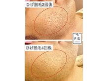 フィズ 経堂店(FIS)/☆脱毛途中経過☆［経堂/脱毛］