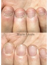 マリーロール 天王寺店(Marie Laure)/自爪育成/深爪矯正/ネイルケア
