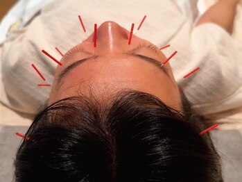 パレット(PALETTE)/【施術風景】鍼灸/小顔整体