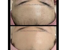 ユニクリア(Uni clear)/ハーブで肌改善