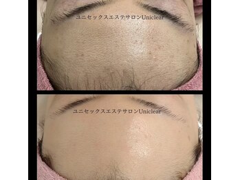 ユニクリア(Uni clear)/ハーブで肌改善