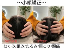 エール シガ(AILE SHIGA)/【小顔矯正】