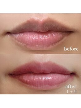 リラ(Lyra)/ローマピンク