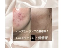 シャインミー(shine me)の雰囲気（最も効果絶大　大人気のグリーンピール）