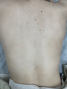 ナノハナ/鹿沼市の全身脱毛のナノハナ