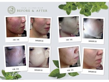 ハーバリー ハーブピーリング 岐阜(HERBERRYハーブピーリング)/ハーブピーリング専門店HERBERRY