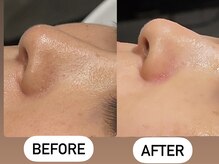 ソーレエルーナ(SOLE e LUNA)/毛穴洗浄 フェイスWAX ワックス 