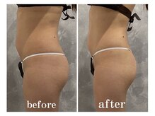 サロン ラズリ 久留米店(SALON Lazuli)/【1回施術】筋膜リリース痩身