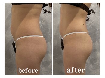 サロン ラズリ 久留米店(SALON Lazuli)/【1回施術】筋膜リリース痩身