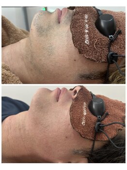 アカラ 読谷店(AKALA)/ヒゲ脱毛