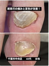 巻き爪じゅん 千葉駅前店/肥厚爪による痛みと変色が改善!