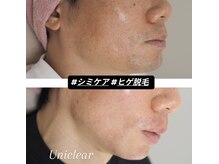 ユニクリア(Uni clear)/佐賀市で男性のシミケア◎人気