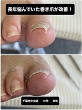 巻き爪じゅん 千葉駅前店/再発した巻き爪も丁寧に対応可能