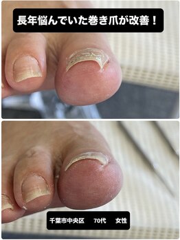 再発した巻き爪も丁寧に対応可能