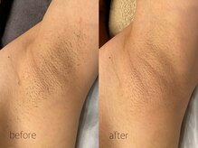 オンセ(once)/ワキ脱毛/全身脱毛