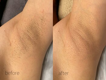 オンセ(once)/ワキ脱毛/全身脱毛