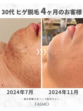 ファスモ(FASMO)/30代 / ヒゲ脱毛 / 4ヶ月目