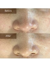 マヴィ(Mavie)/毛穴　Before→After