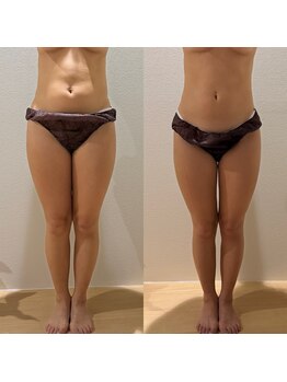 シーアイエステティック 船橋駅前店(c.iエステティック)/痩身コース★1回でスッキリ◎